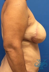 After breast reconstruction Dr. Yegiyants, Santa Barbara, CA