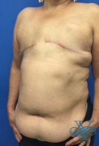Before breast reconstruction Dr. Yegiyants, Santa Barbara, CA