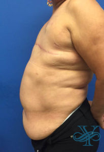 Before breast reconstruction Dr. Yegiyants, Santa Barbara, CA