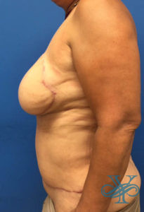 After breast reconstruction Dr. Yegiyants, Santa Barbara, CA