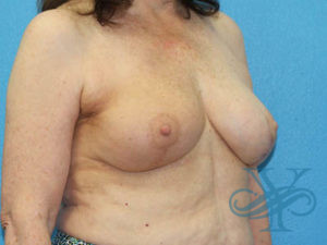 After breast reconstruction Dr. Yegiyants, Santa Barbara, CA