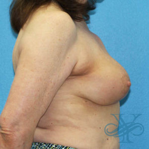 Before breast reconstruction Dr. Yegiyants, Santa Barbara, CA
