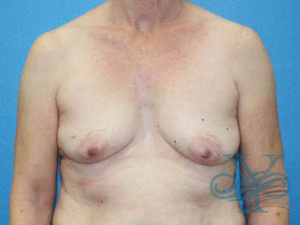 Before breast reconstruction Dr. Yegiyants, Santa Barbara, CA