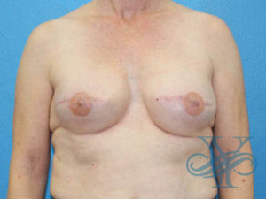 After breast reconstruction Dr. Yegiyants, Santa Barbara, CA