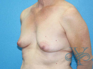 BEfore breast reconstruction Dr. Yegiyants, Santa Barbara, CA