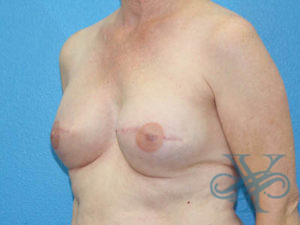 After breast reconstruction Dr. Yegiyants, Santa Barbara, CA
