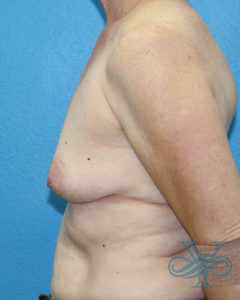 Before breast reconstruction Dr. Yegiyants, Santa Barbara, CA
