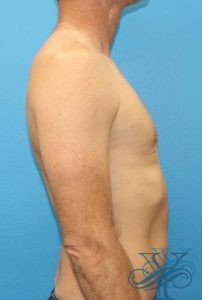 after gynecomastia Dr. Yegiyants, Santa Barbara, CA