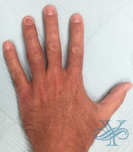 After reconstructive surgery Dr. Yegiyants, Santa Barbara, CA