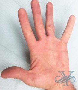 After reconstructive surgery Dr. Yegiyants, Santa Barbara, CA