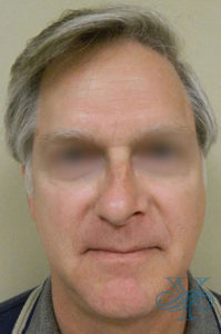 Before rhinoplasty Dr. Yegiyants, Santa Barbara, CA