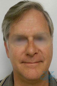 After rhinoplasty Dr. Yegiyants, Santa Barbara, CA
