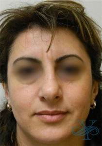 Before rhinoplasty Dr. Yegiyants, Santa Barbara, CA