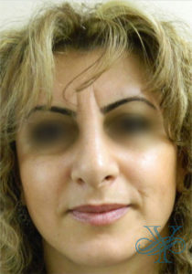 After rhinoplasty Dr. Yegiyants, Santa Barbara, CA