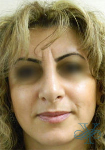 After rhinoplasty Dr. Yegiyants, Santa Barbara, CA
