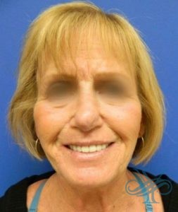 Before rhinoplasty Dr. Yegiyants, Santa Barbara, CA