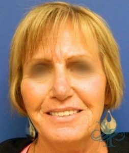 After rhinoplasty Dr. Yegiyants, Santa Barbara, CA