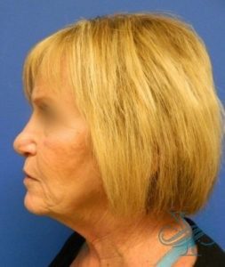 After rhinoplasty Dr. Yegiyants, Santa Barbara, CA