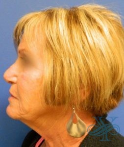 Before rhinoplasty Dr. Yegiyants, Santa Barbara, CA