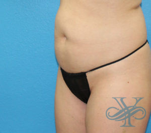 Before sculpsure Dr. Yegiyants, Santa Barbara, CA