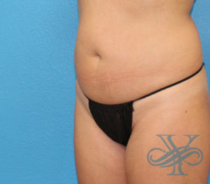 After sculpsure Dr. Yegiyants, Santa Barbara, CA