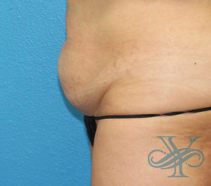 Before sculpsure Dr. Yegiyants, Santa Barbara, CA