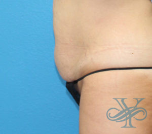 After sculpsure Dr. Yegiyants, Santa Barbara, CA