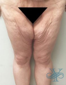 Before thigh lift Dr. Yegiyants, Santa Barbara, CA