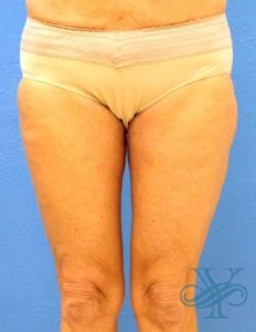 After thigh lift Dr. Yegiyants, Santa Barbara, CA