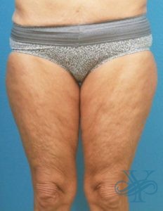 Before thigh lift Dr. Yegiyants, Santa Barbara, CA