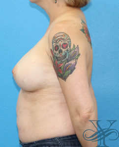After breast augmentation Dr. Yegiyants, Santa Barbara, CA