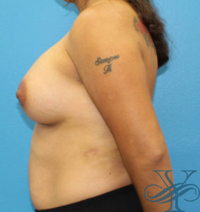 After breast augmentation Dr. Yegiyants, Santa Barbara, CA