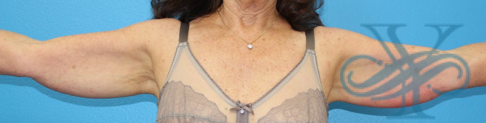 Before coolsculpting Dr. Yegiyants, Santa Barbara, CA