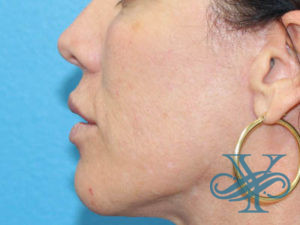 Before microneedling Dr. Yegiyants, Santa Barbara, CA