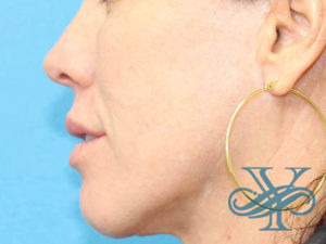 After microneedling Dr. Yegiyants, Santa Barbara, CA