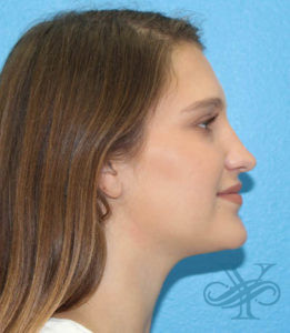 Before rhinoplasty Dr. Yegiyants, Santa Barbara, CA