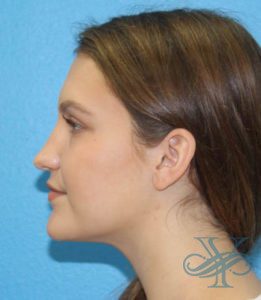 Before rhinoplasty Dr. Yegiyants, Santa Barbara, CA