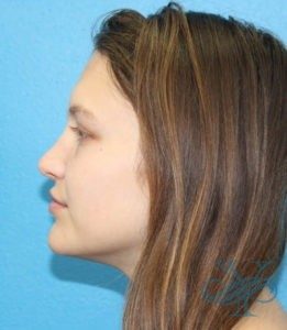 After rhinoplasty Dr. Yegiyants, Santa Barbara, CA
