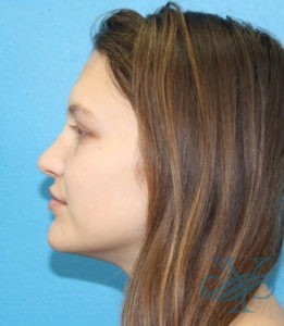 After rhinoplasty Dr. Yegiyants, Santa Barbara, CA