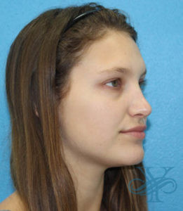 After rhinoplasty Dr. Yegiyants, Santa Barbara, CA