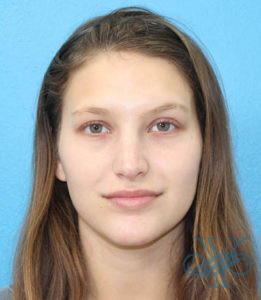 After rhinoplasty Dr. Yegiyants, Santa Barbara, CA