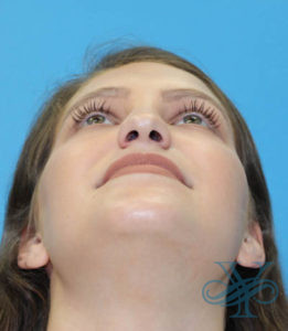 After rhinoplasty Dr. Yegiyants, Santa Barbara, CA