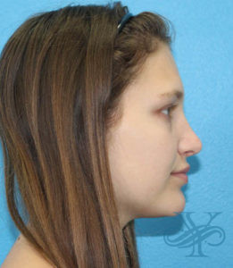 After rhinoplasty Dr. Yegiyants, Santa Barbara, CA