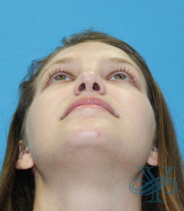 Before rhinoplasty Dr. Yegiyants, Santa Barbara, CA