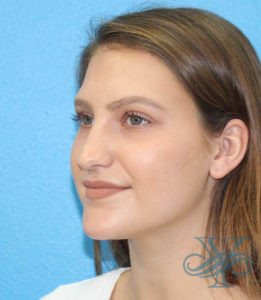 Before rhinoplasty Dr. Yegiyants, Santa Barbara, CA