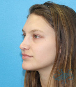 After rhinoplasty Dr. Yegiyants, Santa Barbara, CA