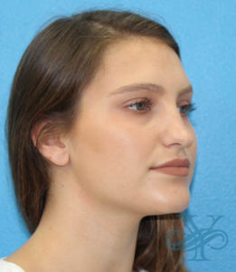 After rhinoplasty Dr. Yegiyants, Santa Barbara, CA