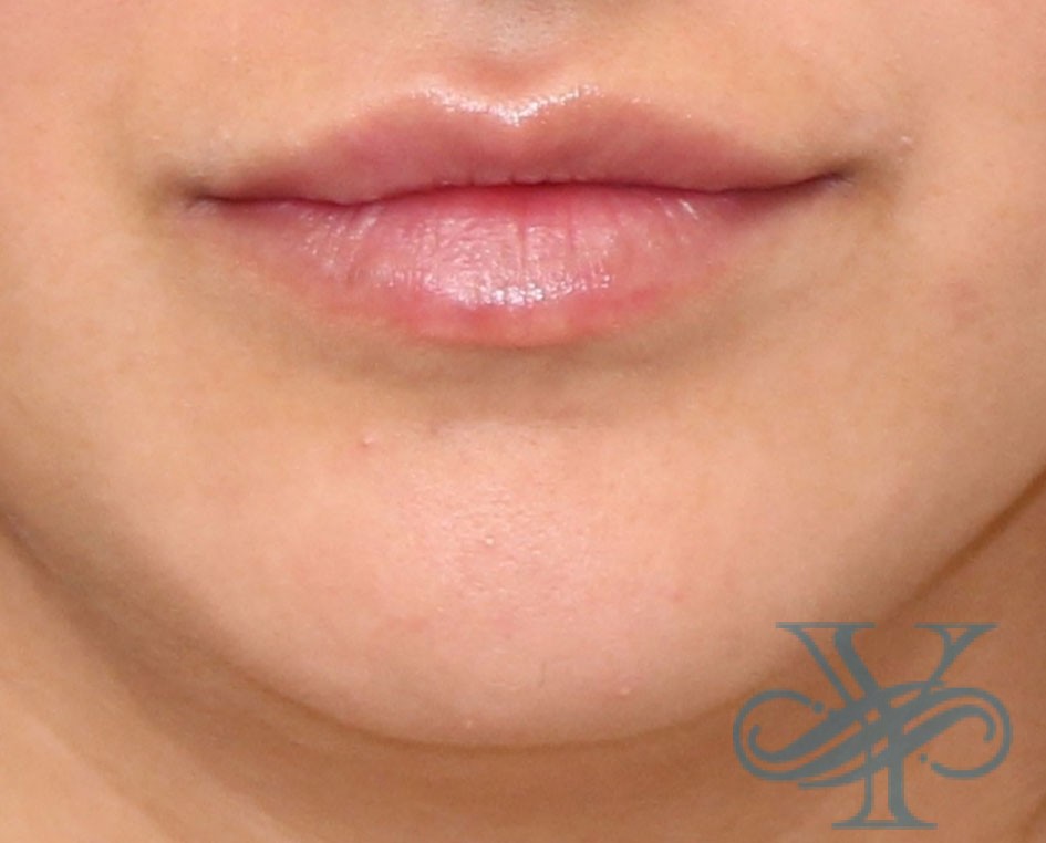 After lip injection Dr. Yegiyants, Santa Barbara, CA