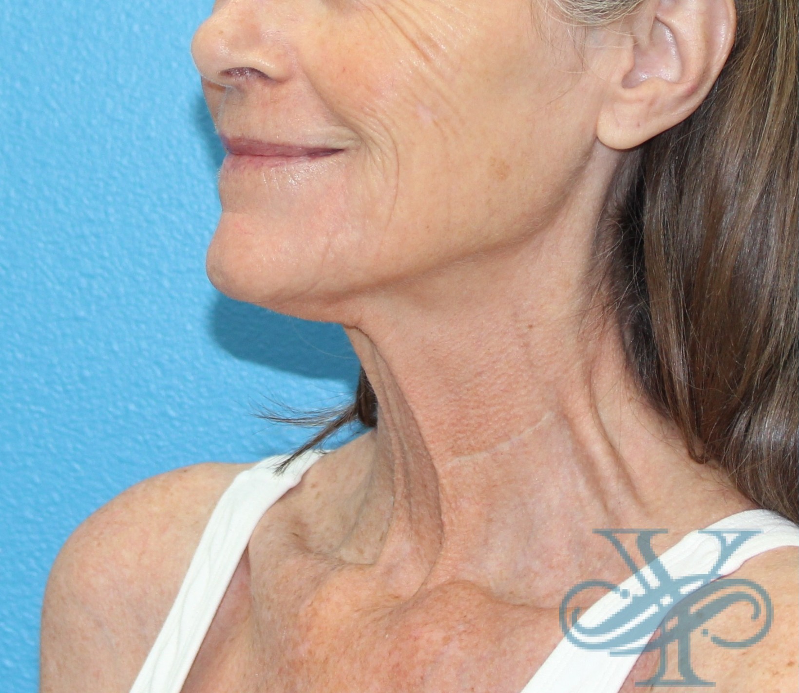 Before necklift Dr. Yegiyants, Santa Barbara, CA