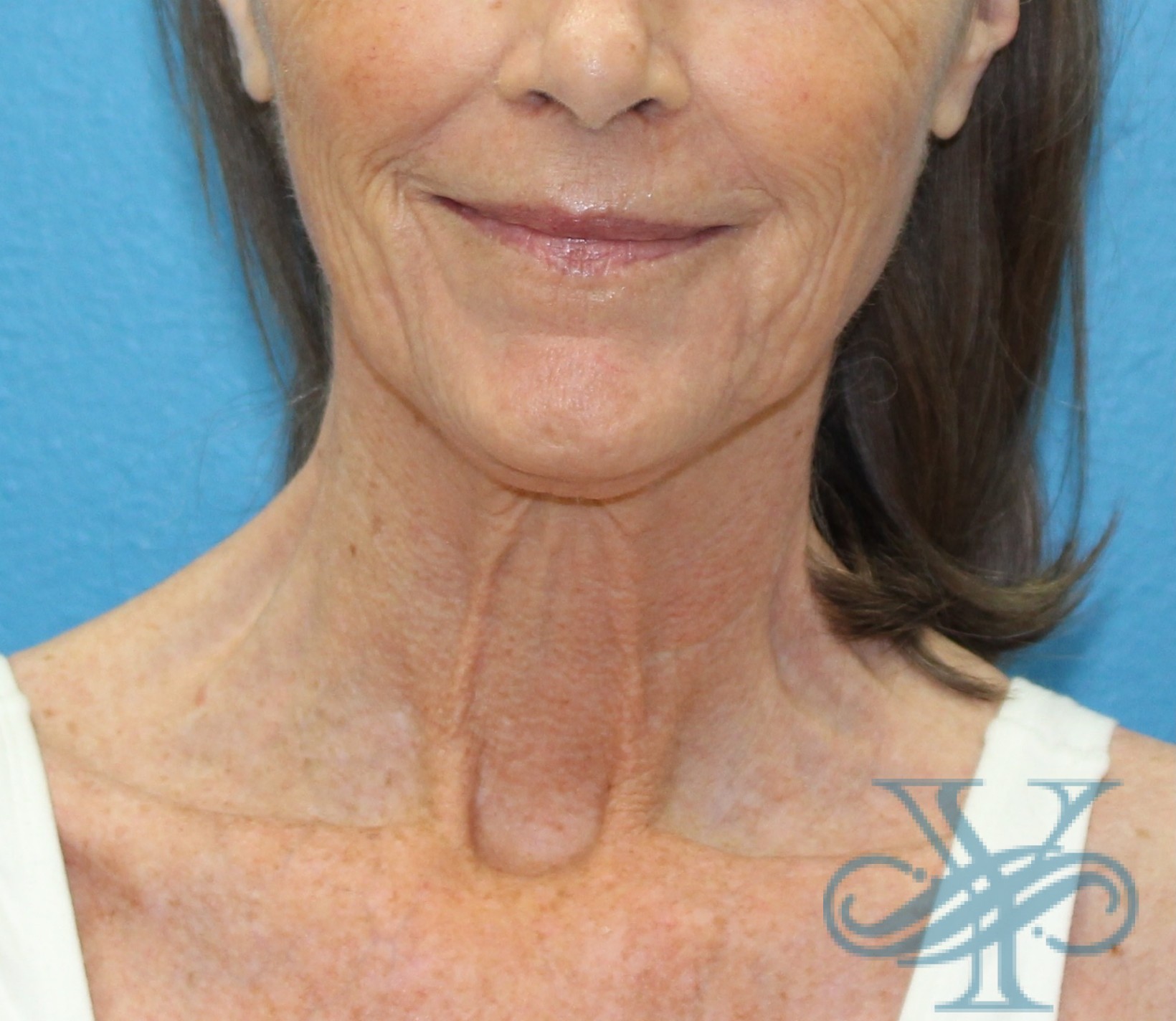 Before necklift Dr. Yegiyants, Santa Barbara, CA
